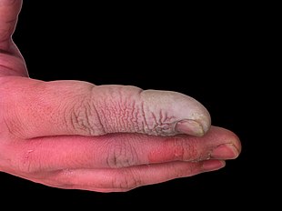 A hydrofluoric acid burn of the hand 61569264 jamesheilman-224x2991.jpg