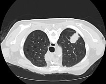 CT scan- adenocarcinoma of the left lung Adenocarcinoma - CT scan (5499628365).jpg