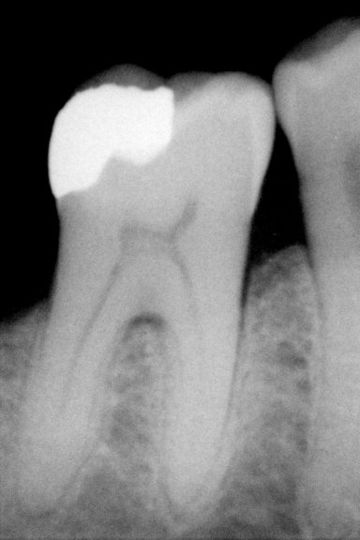 File:Amalgam filling.JPG