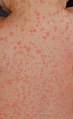 服用阿莫西林初次劑量八天後的非過敏性皮疹：此照片攝於皮疹開始出現後的24小時。