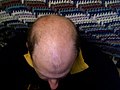 A scalp without much hair