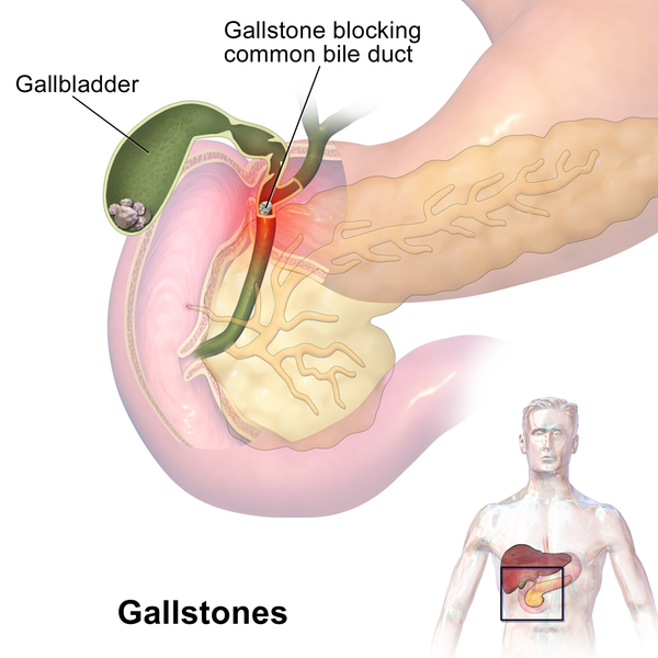 File:Gallstones.png