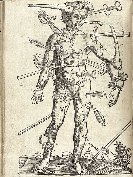 An illustration of the Wound Man, showing a variety of wounds from the Feldbuch der Wundarznei (Field manual for the treatment of wounds) by Hans von 