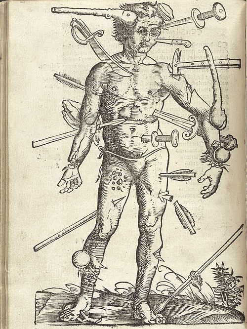 An illustration of the Wound Man, showing a variety of wounds from the Feldbuch der Wundarznei (Field manual for the treatment of wounds) by Hans von 