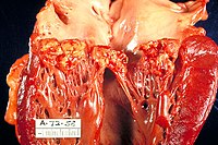 Endocarditis