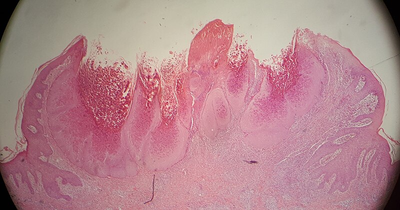 File:Low magnification micrograph of a molluscum contagiosum lesion.jpg