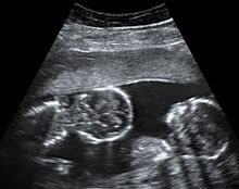 Abdominal ultrasonography of monoamniotic twins at a gestational age of 15 weeks. There is no sign of any membrane between the fetuses. A coronal plane is shown of the twin at left, and a sagittal plane of parts of the upper thorax and head is shown of the twin at right. Monoamniotic twins at 15 weeks.jpg