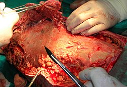 Necrotic tissue from the left leg surgically removed
