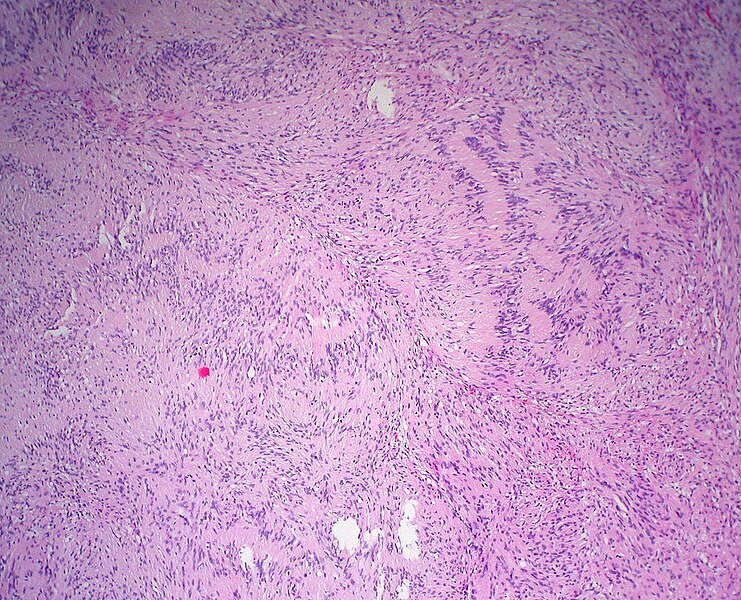 File:Plexiform Schwannoma 4.jpg