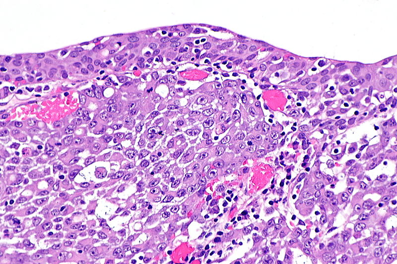 File:Renal medullary carcinoma - alt1 -- high mag.jpg