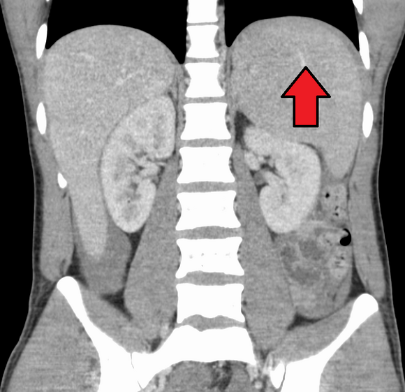 Splenomegaly due to mononucleosis resulting in a subcapsular hematoma
