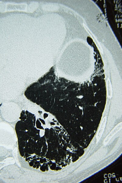 File:Systemic sclerosis case 32 pic 20.jpg