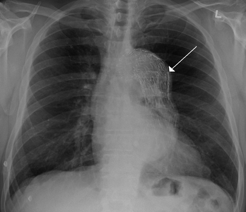 Stent umístěný v aneurysmatu hrudní aorty