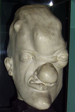 Model of a head of a person with tertiary (gummatous) syphilis, Musee de l'Homme, Paris Tertiary syphilis head.JPG