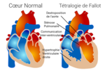 Vignette pour Tétralogie de Fallot