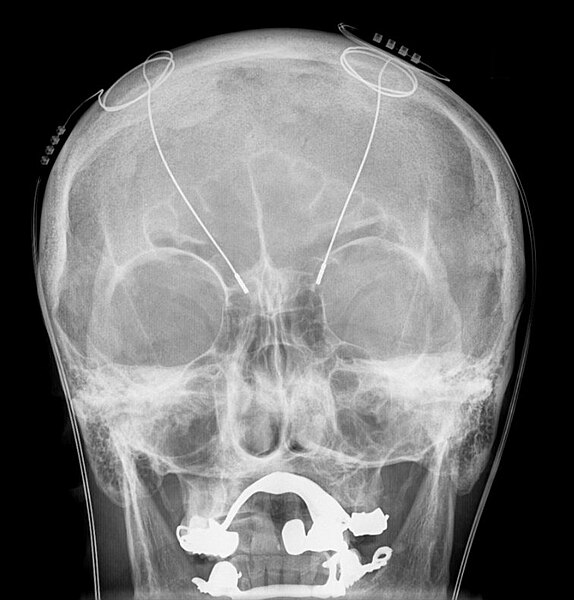 File:Tiefe Hirnstimulation - Sonden RoeSchaedel ap.jpg