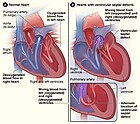 Vergleich eines normalen Herzes (links) und eines mit Ventrikelseptumdefekt (rechts). Der hier abgebildete Herzfehler ermöglicht in zwei häufigen Fällen das Vermischen von sauerstoffreichem und sauerstoffarmen Blut. Dies kann in einer Herzkammer selbst und/oder an ihrer Scheidewand passieren.