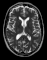 001 Arteriovenous Malformation MRT T2 axial.gif