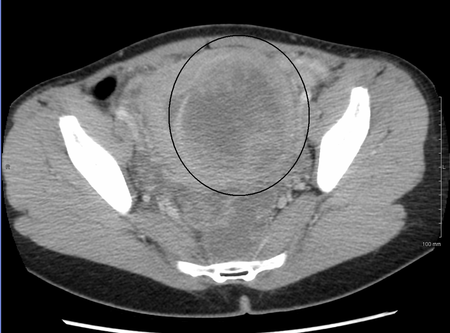 ไฟล์:9cmFibroidPelvicCongestionS.png