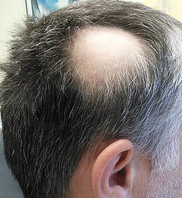 Alopecia areata 2