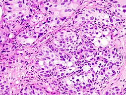 Bladder urothelial carcinoma histopathology (2) at trigone.jpg