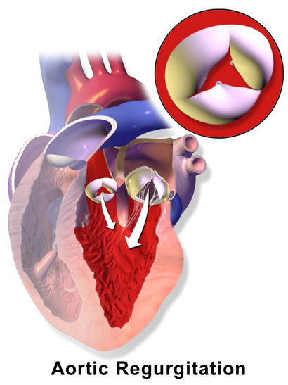 Blausen 0039 AorticRegurgitation.png