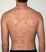 The back of a 30-year-old male after 5 days of the rash