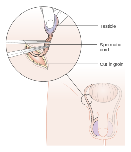 Diagram showing how the testicle is removed (orchidectomy) CRUK 141.svg