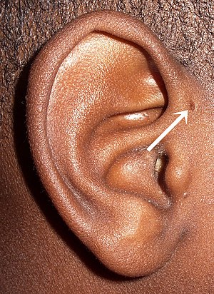 Fistule Oreille.jpg