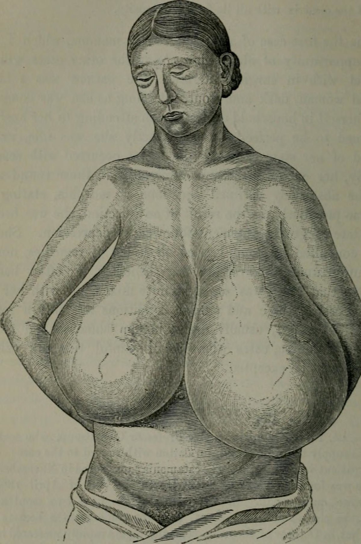 Breast hypertrophy Wikipedia