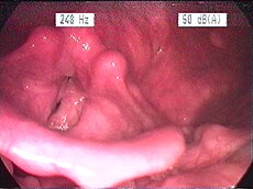 Laryngitis - Wikipedia, the free encyclopedia