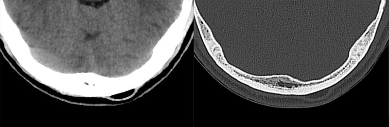 File:Lipom der Kopfschwarte okzipital 59M - CT axial - 001.jpg