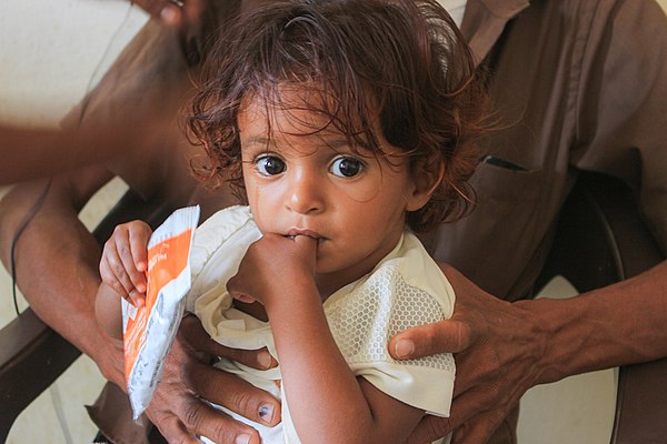 A child holds a WFP supplementary, specialized food to treat malnutrition among children, at a WFP-supported nutrition clinic in Yemen. Photo: WFP/Iss