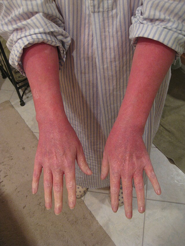 Forhandle Tid opdagelse File:Red (burning) Skin Syndrome - Typical Pattern of Lower Arms & Hands.jpg  - Wikimedia Commons