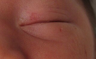 <span class="mw-page-title-main">Midline nevus flammeus</span> Vascular birthmark