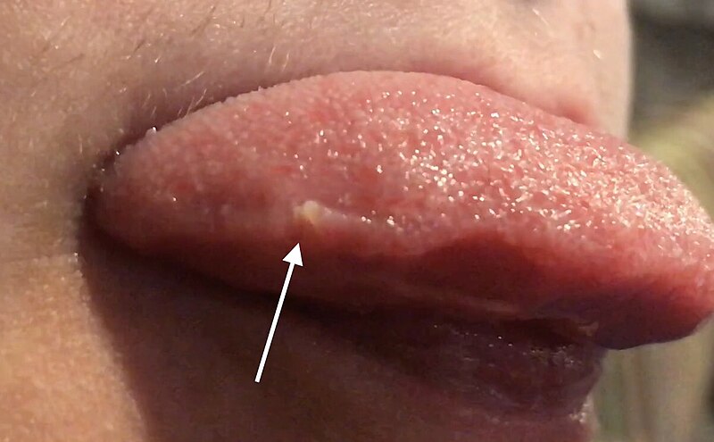 inflamed circumvallate papillae