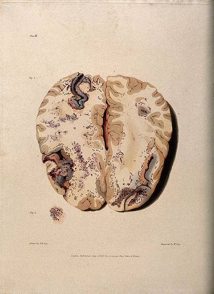 File:Two sections of diseased brain. Coloured stipple etching by Wellcome V0009768.jpg