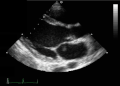 Szívbillentyű ultrahangos felvétele EKG-val