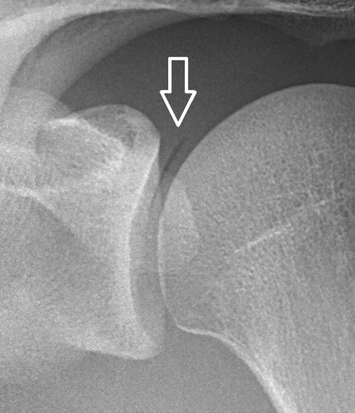 File:X-ray of shoulder with vacuum sign - annotated.jpg