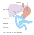 Thumbnail for Pancreatectomy