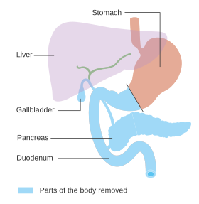 Diagram met het gebied dat is verwijderd voor een operatie om alle pancreas te verwijderen (totale pancreatectomie) CRUK 287.svg