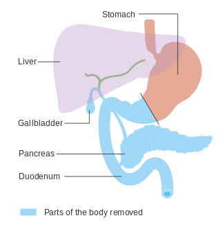 <span class="mw-page-title-main">Pancreatectomy</span> Surgical removal of the pancreas