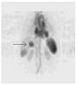 A nuclear medicine SPECT liver scan with technetium-99m labeled autologous red blood cells. A focus of high uptake (arrow) in the liver is consistent with a hemangioma.