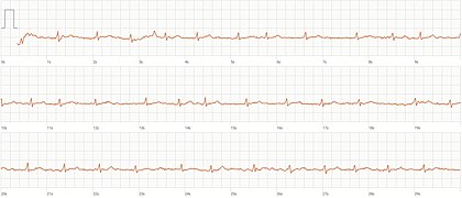 1-Kanal-EKG von Vorhofflimmern
