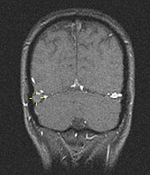خثار الجيب الوريدي المخي (الإشارات الصفراء) كما يظهر في تصوير بالرنين المغناطيسي
