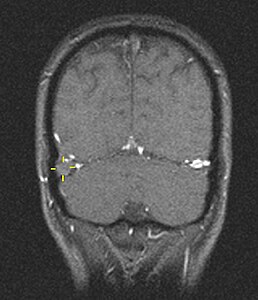 MBq sinusvenenthrombose.jpg