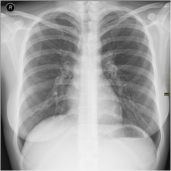 File:Medical X-Ray imaging OSC06 nevit.jpg