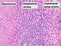 Myometrium (smooth muscle cells) versus endometrial stroma (more cellular) versus endometrial polyp stroma (more collagenous). H&E stain