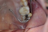 Palatal Lift Prosthesis Composite Resin Retention.JPG