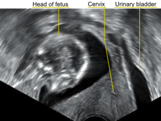 <span class="mw-page-title-main">Retroverted uterus</span> Medical condition